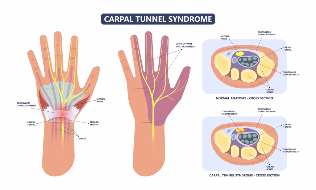 Patient wearing wrist brace for carpal tunnel treatment in Gulshan