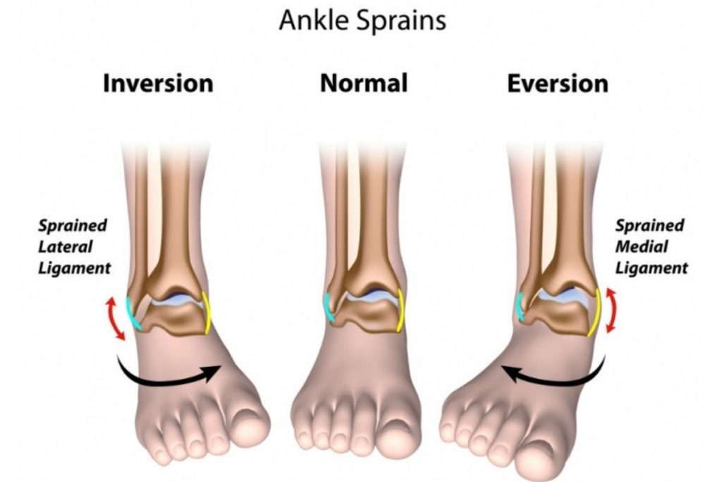 Ankle sprain rehab exercise guide for ankle sprain physiotherapy Gulshan