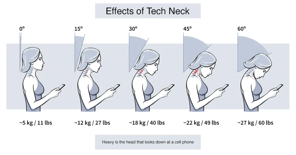 Forward head posture weight chart for text neck treatment in Gulshan